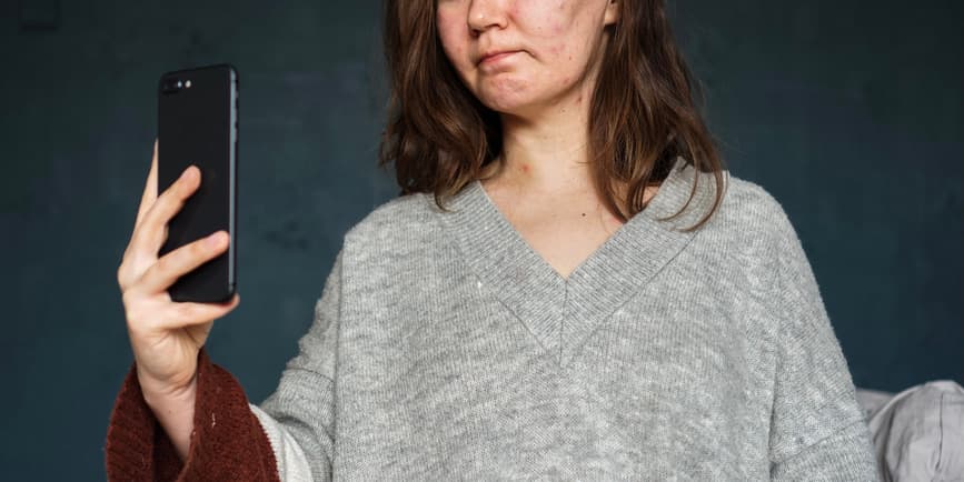 Mujer infectada por el virus de la varicela (varicela), con la cara y el pecho cubiertos de espinillas inflamadas causadas por el acné, haciéndose una selfie
